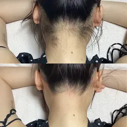 うなじ脱毛🌼で全方向美人！日頃の不快感・コンプレックスを解消🌱*・