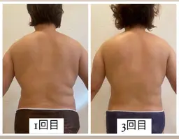 ⭐️ミニモ限定⭐️キャビテーション✖️クラッシュ吸引！上半身痩身（背中・お腹・腰回り）痩身マシーンで温め＆セル撃退40分