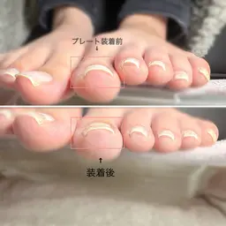巻き爪矯正(一趾) ドライケア込
