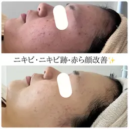 10/10​〜​10/23限定🎊ゲリラクーポン！水光ツヤ肌ピーリング🫧一度で透明感・ハリ・艶アップ⤴️艶々美肌に❤︎