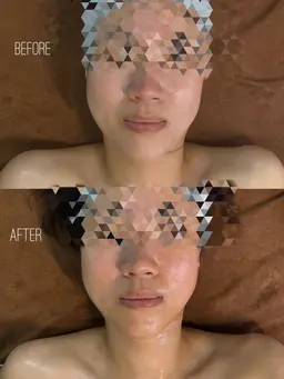 【小顔・リフトアップ】生体電流セラピー⚡️KB小顔リフティングフェイシャル　※所要時間60分