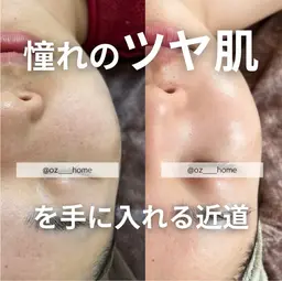 新規【お得！結果重視】ハーブピーリング+悩み別オプション2種＋小顔矯正