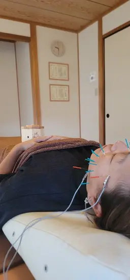 [眼精疲労・エラの張り特化]初回美容鍼(ヘッドスパ付き)