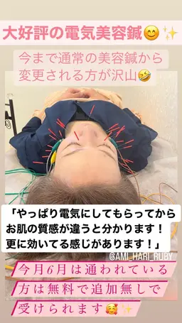 【即効リフトアップ‼️小顔電気美容鍼】(頭皮鍼＋美顔鍼＋EMS高周波+肩ほぐし＋ヒト幹細胞培養液導入)