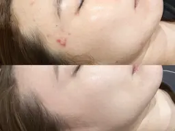 【新規】最先端美肌施術プラズマシャワー照射+美容液導入【ニキビ/肌荒れ/角質ケア】