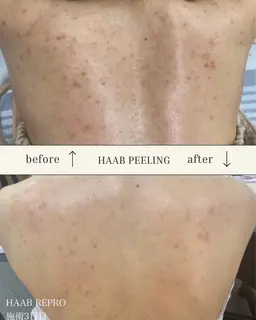 【ハーブピーリング/背中】※ダウンタイムあり