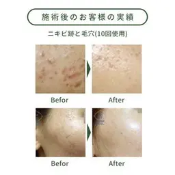 ピーリングモデル（剥離なし）撮影モデル