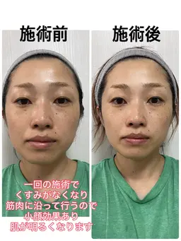 老化角質除去!古い角質よ!さようなら!フェイシャル体験2,980円