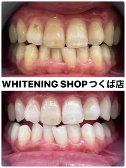 【人気No.1★お試しセルフホワイトニング2回】20分×2回の40分照射¥6,600→¥1,980
