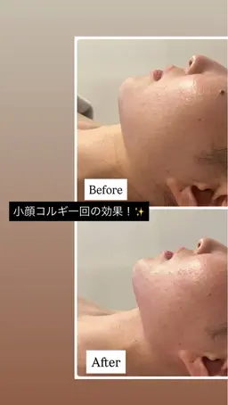 《クリスマスキャンペーン🎄✨》小顔コルギ＋ハイパーナイフW効果‼️