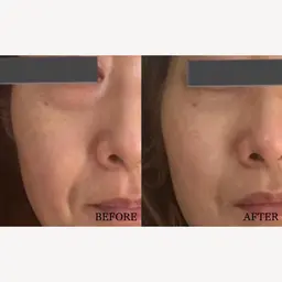 頬毛穴撃退コース！サーマトリックス頬×幹細胞導入￥20,050→￥11,000