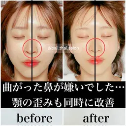 【鼻集中】鼻の歪み・曲がり・低い人向け体験［小顔矯正/鼻・頬骨/上顎骨］