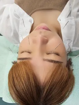 シミ、しわ、むくみはこれで解決!顎もスッキリして笑顔も素敵✨       ⦿美顔鍼
