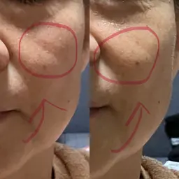 【憧れ小顔】フェイシャルエステ✨超音波振動、たるみケア、保水力アップ、キメを整えシミシワにもアプローチ。