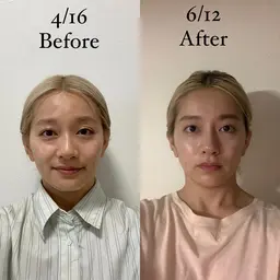 小顔セラピア　痛くない　撫でるだけ　※InstagramにBefore After載せさせて頂きます◎