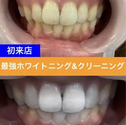 【最強セルフホワイトニング】クリーニング&効果2倍ジェル LED照射15分×2回　¥6600