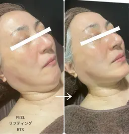 【マイナス5歳肌へ】切らない、痛くないけど整形級！たるみ・ほうれい線・小皺を無くしてリフトアップ！WISH PRO