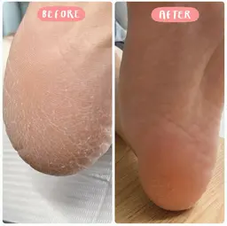 🦶つるつる角質🌟フットケアモニター募集🦶