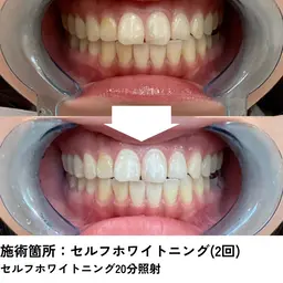 【セルフホワイトニング】プレミアムケア‎💎高濃度配合ジェル×ハイパワー3色LEDで効果実感✨20分×2回