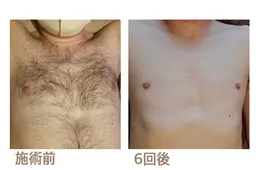 清潔感爆上がり✨Men's全身脱毛(VIOなし)✨