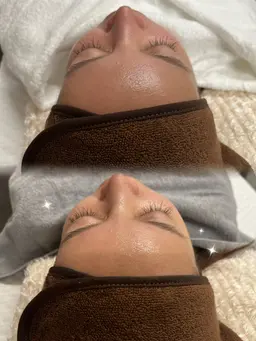 ハーブピーリング(剥離無) 【通常】¥5000▶︎【オープン記念価格】¥4660