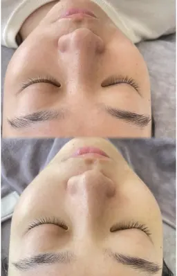 韓国最新 光フェイシャル