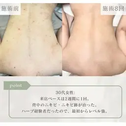【背中ニキビケア】剥けるハーブピーリング＋鎮静パック/背中（上or下）
