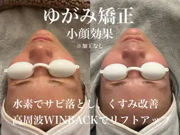 【全営業時間】秋の毛穴シミ撲滅!美白美肌へ!水素高周波のWアプローチ!フェイシャルエステ体験