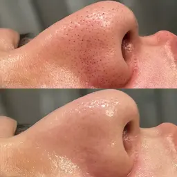 鼻のみWAX脱毛×鼻のみ毛穴洗浄