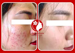 (2回体験)🈹各種ニキビ・肌あれ•ニキビ跡•敏感肌•赤ら顔•肌トラブルケア(特別毛穴洗浄とヘッドマッサージ)