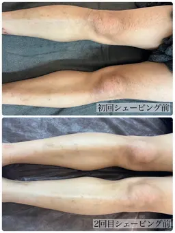 メンズ全身脱毛(顔/VIO込)