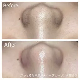 【シミシワ・ニキビ・毛穴・美白】国産肌育ハーブピーリングベーシックコース60分🌿