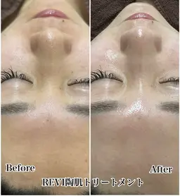 【美肌×コルギ】REVI陶肌トリートメント＋デコルテor頭コルギ15分