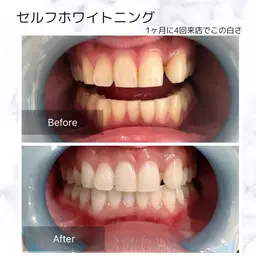 【イメージリノベーション】セルフホワイトニング