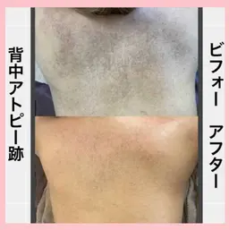 🌿Bodyハーブピーリング🌿(剥離あり)背中、腰、二の腕、お尻、デコルテ等🩵吹き出物、毛穴のザラつき、色跡に🩵