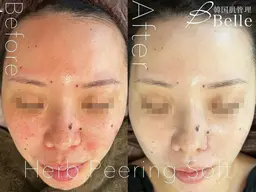 《クリスマスまで限定🎄》ハーブピーリングソフト(フェイシャルor背中or二の腕)