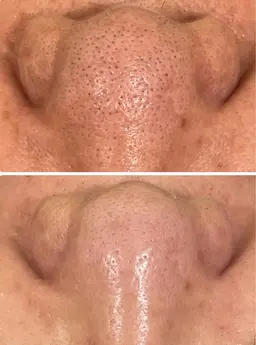 毛穴洗浄✨こんな黒ずみにお悩みの方!モニター様