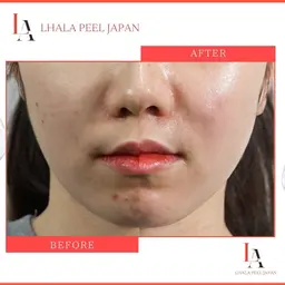 初回限定✨【韓国🇰🇷で大人気💆‍♀️最新第4世代ピーリング】ララピール🖌️💕DT一切なし✖×即効性💎◎
