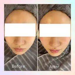 【ハイドラフェイシャル×ポテンツァ】