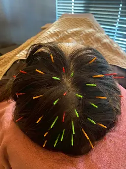 ヘッドスパ鍼で艶髪✨頭皮の鍼は究極のヘッドスパ❣️艶髪になりたいなら✨