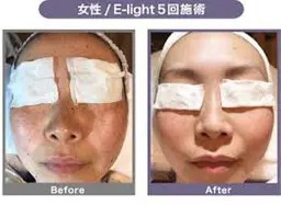 フェイシャル&保湿美容パック付き!肌のたるみ、シワ、シミの予防効果!個人差はございますが、シミ、シワが薄くなってきます。