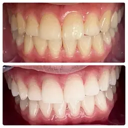 【当日限定】歯の黄ばみにセルフホワイトニング体験メニュー🦷8分×3回で効果実感🩵セルフで簡単本格ケア✨駅チカ