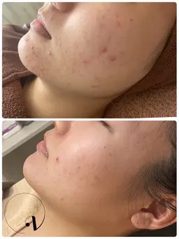 ミニモ限定【自信を取り戻す肌へ!ニキビ解消モニター、限定6名様🌿受付中!】大人気💓剥離ありハーブピーリング3回セット