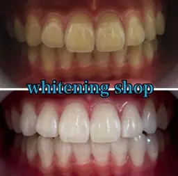 【2回目以降回数券お持ちでない方】ホワイトニング20分×2回照射¥8,800