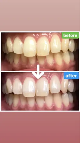 初回 人気No.1❤️一度でも白さを体験!🦷ホワイトニング🦷4000円!10分+15分+20分/3回照射(45分)