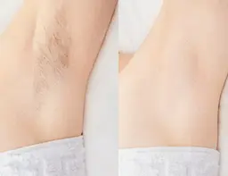 ワキ脱毛