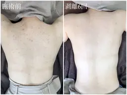 【背中ハーブピーリング】ニキビにアプローチ★艶肌背中コース※Google口コミ必須