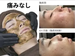【メンズニキビ跡ケア】全顔ハーブピーリング＋保湿マスク¥9,900