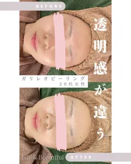 【短期間集中🌟高濃度炭酸美容液ガリレオピーリング】2回目以降❣️嬉しい！デコルテマッサージ付き❣️