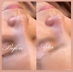 限定3名【毛穴洗浄フェイシャル】(全顔)新鮮な水素水でごっそり汚れ取り★毛穴のザラつき,いちご鼻,黒ずみ,ニキビケアに♪